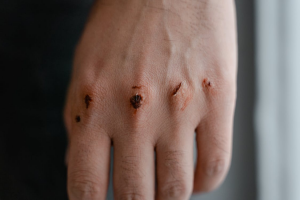 physical injuries due to personal injury case