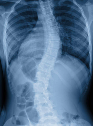 Xray showing severe Scoliosis