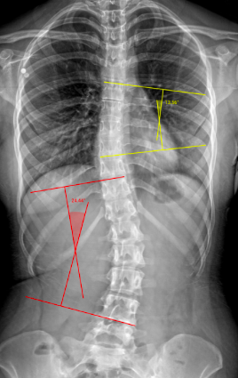 Xray showing gradation of Scoliosis