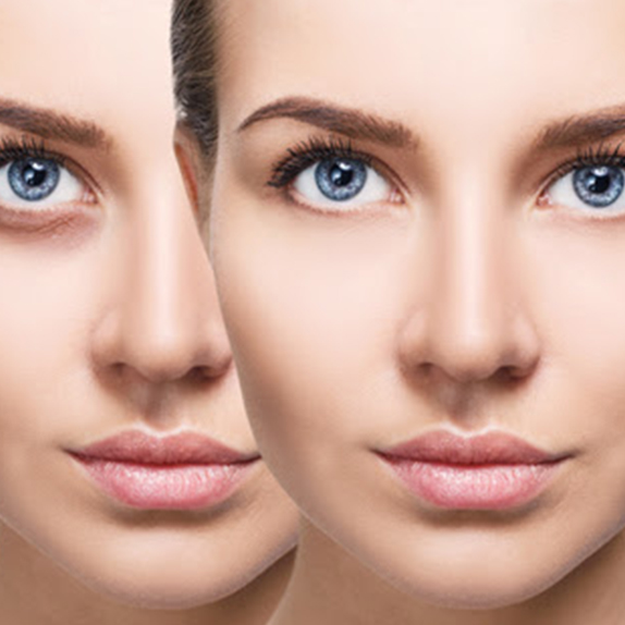 Tear Trough Fillers