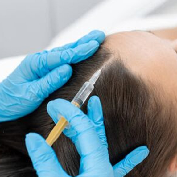 Platelet Rich Plasma (PRP) for Hair loss