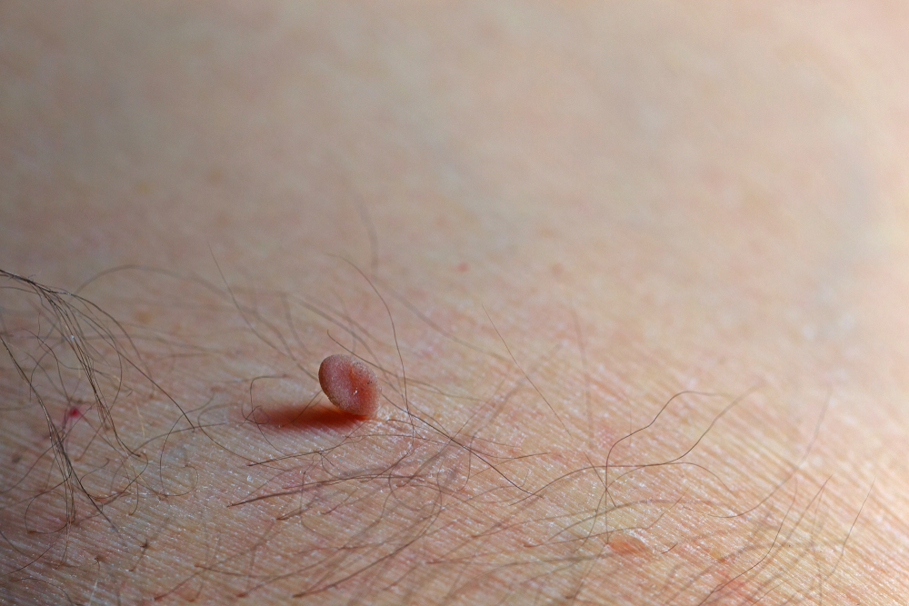 Skin Tag Removal