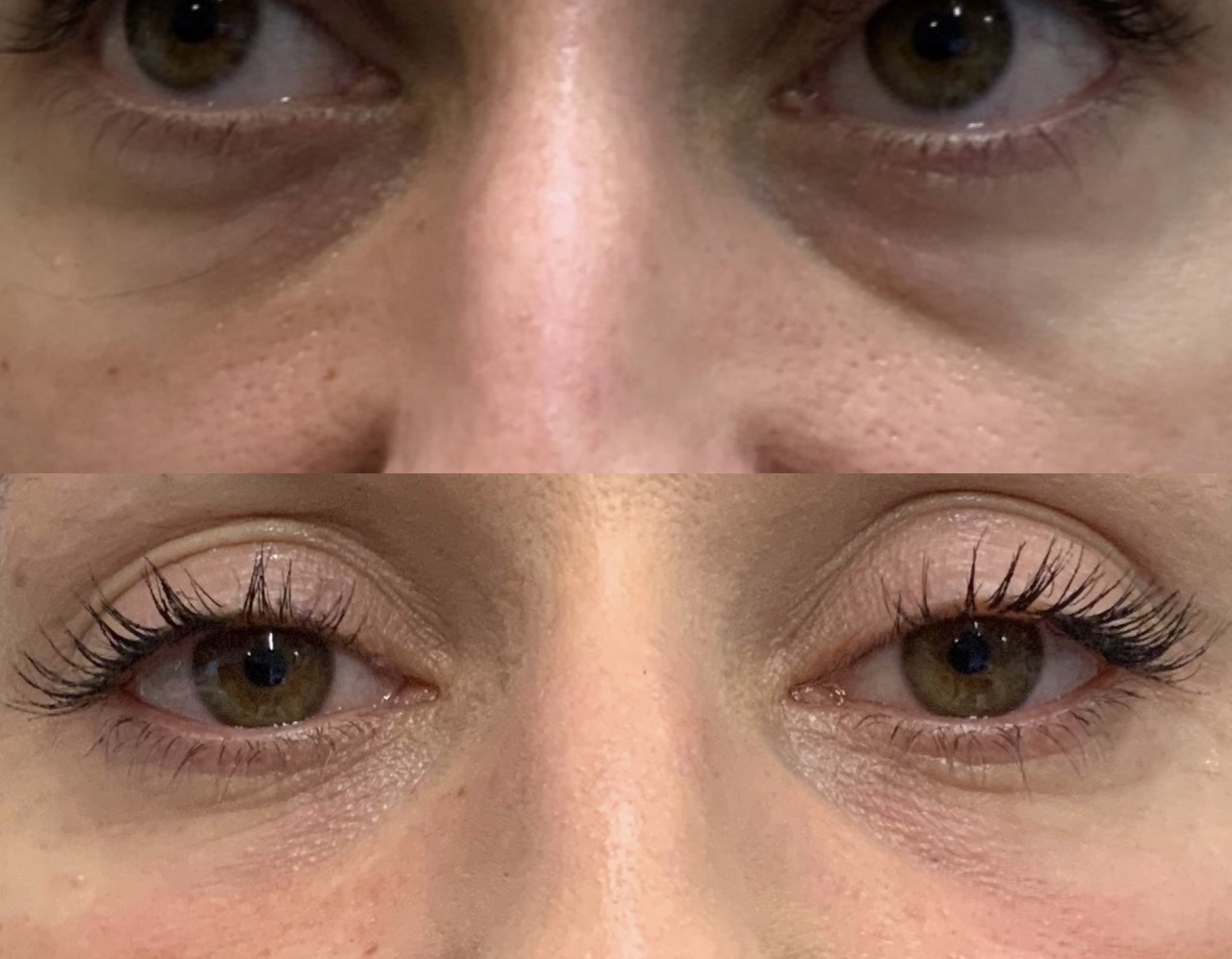 Platelet Rich Plasma (PRP) for Dark Circles under eyes