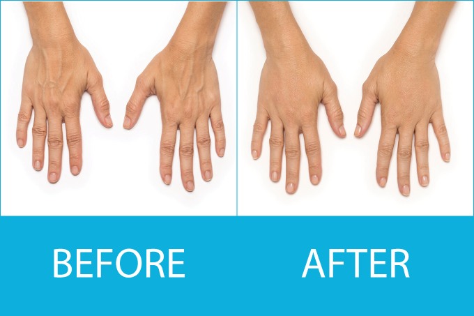 Platelet Rich Plasma (PRP) for Hand rejuvenation