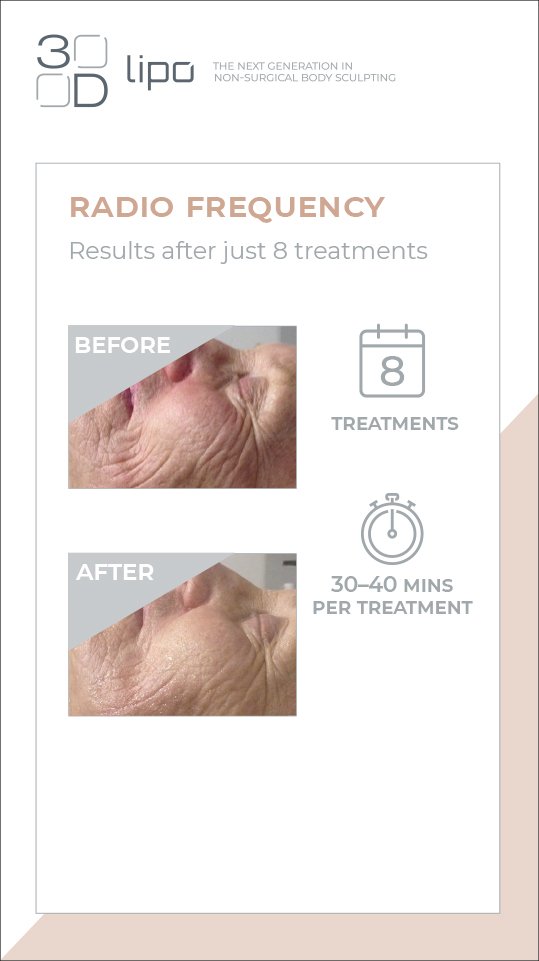 Radiofrequency Skin Tightening