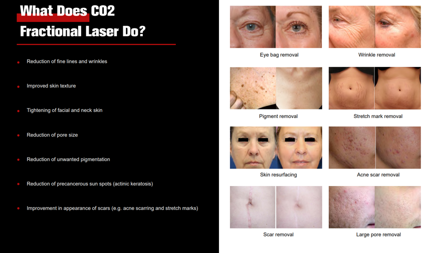 Fractional Co2 laser skin resurfacing