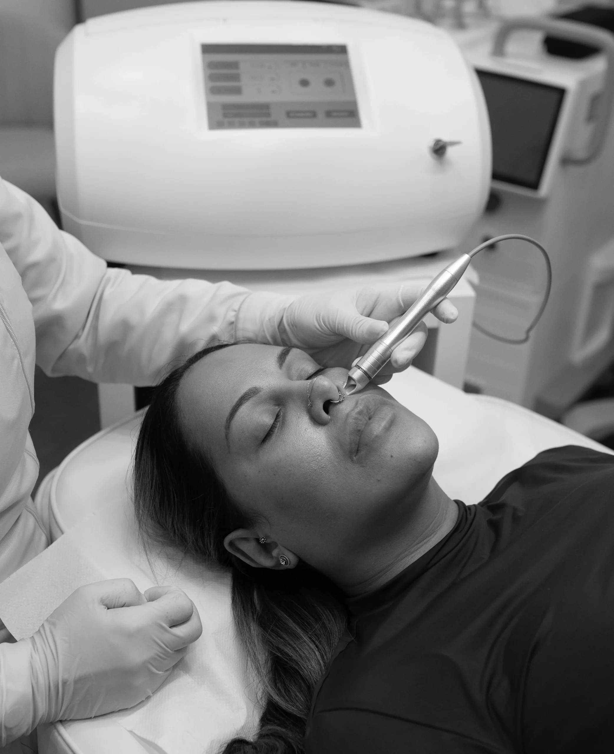 Laser Thread Vein & Vascular Lesion Removal Training