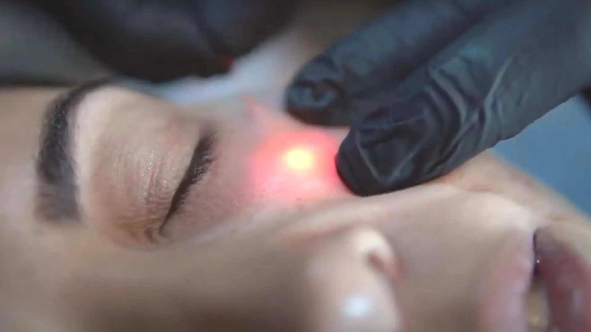 RejuvaLift®- Endolifting + Tumescent Lidocaine